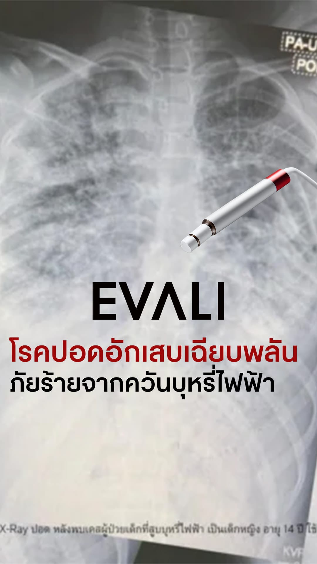 โรคปอดอักเสบเฉียบพลัน